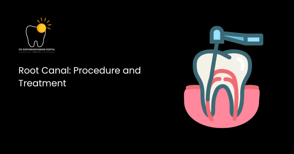 Root Canal: Procedure and Treatment