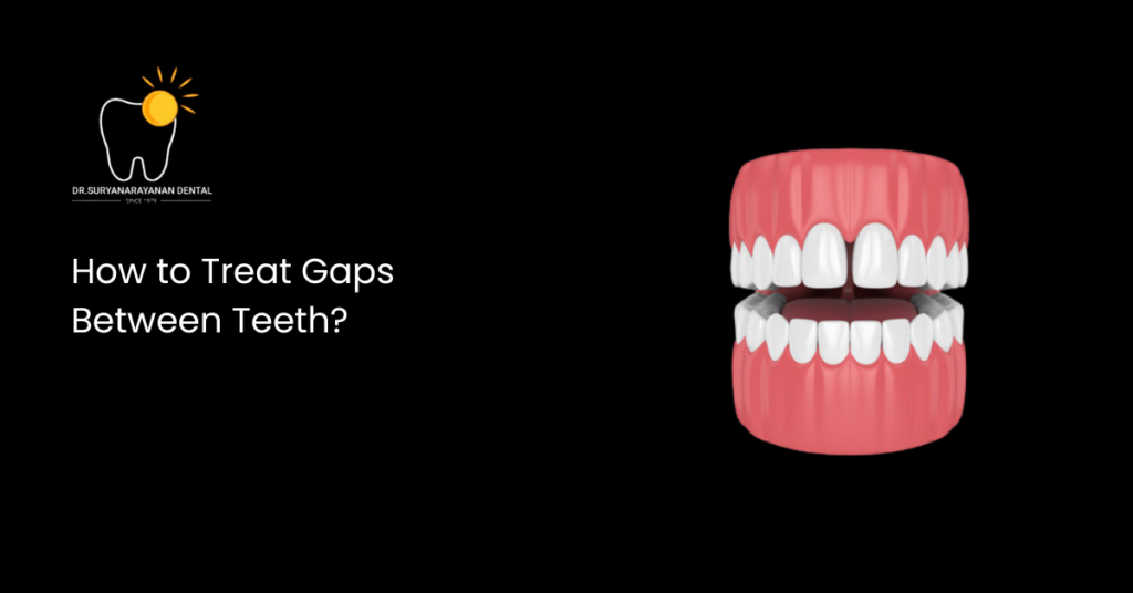 How to Treat Gaps Between Teeth?