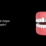 How to Treat Gaps Between Teeth?