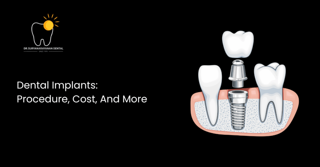 Dental Implants: Procedure, Cost, And More