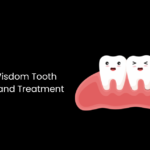 Impacted Wisdom Tooth Symptoms and Treatment