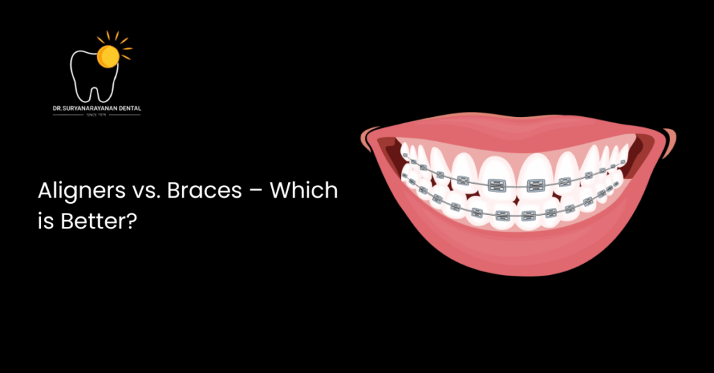 Aligners vs. Braces – Which is Better?