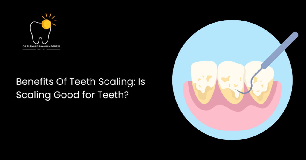 Benefits Of Teeth Scaling: Is Scaling Good for Teeth?