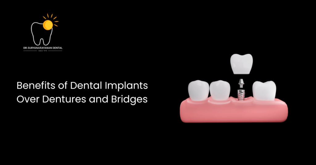 Benefits of Dental Implants Over Dentures and Bridges