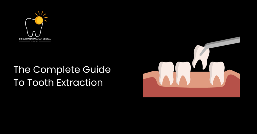 The Complete Guide To Tooth Extraction