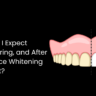 What Can I Expect Before, During, and After My In-Office Whitening Treatment?