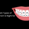 Types of Braces