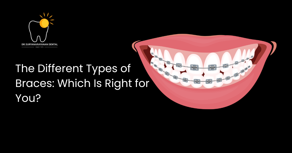 Types of Braces